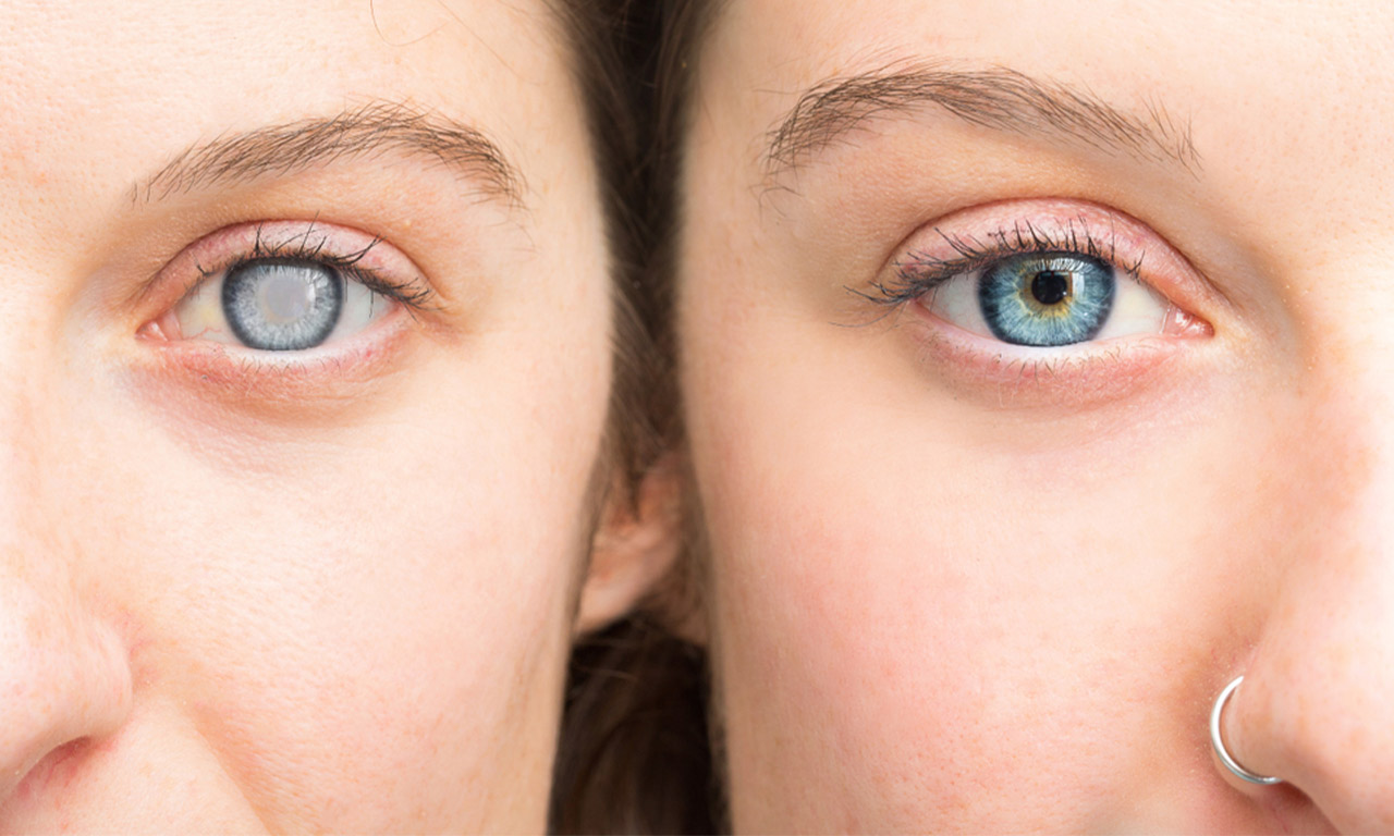 Can Cataracts Come Back?