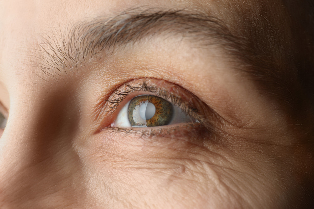 How Soon Can You Travel After Cataract Surgery?