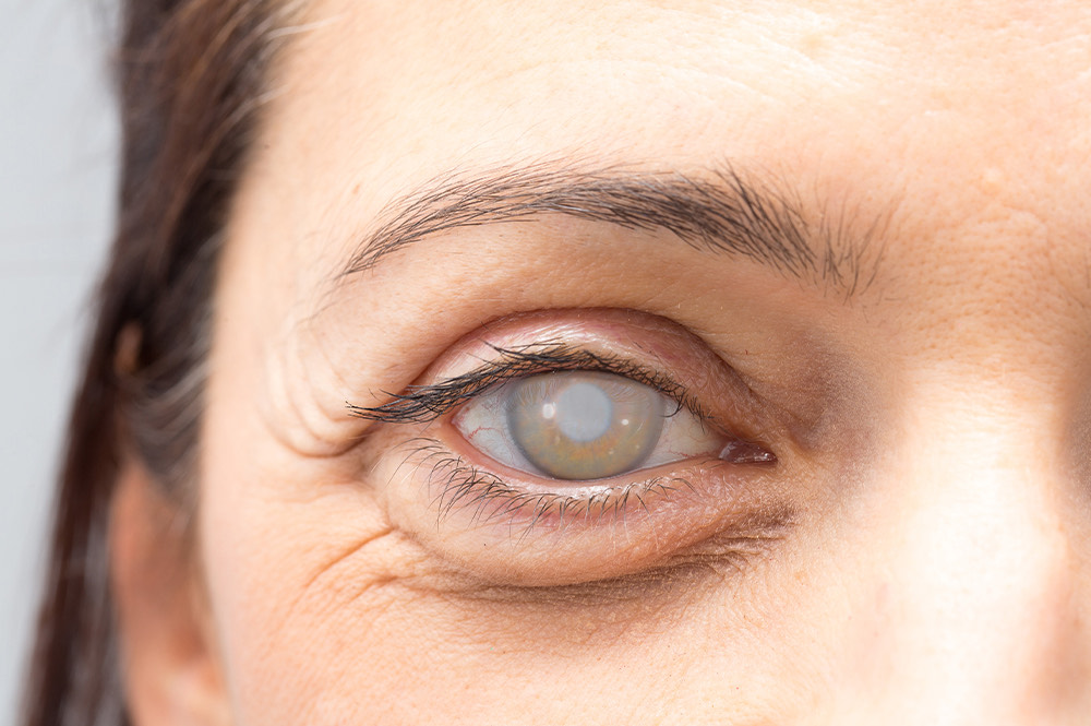How early can cataracts appear?