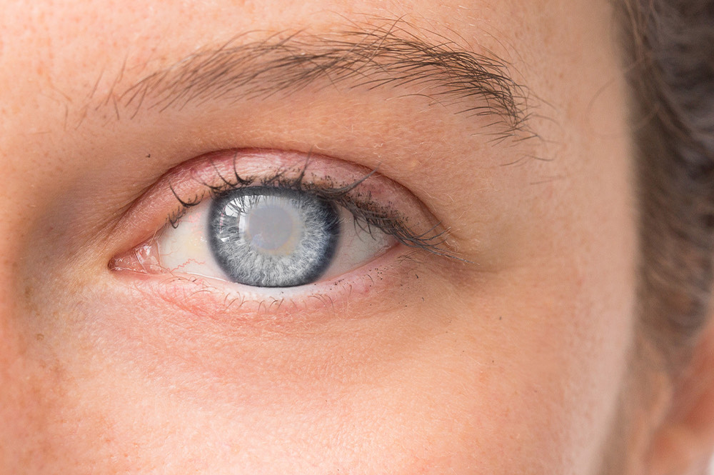 How Long Does Cataract Surgery Take?