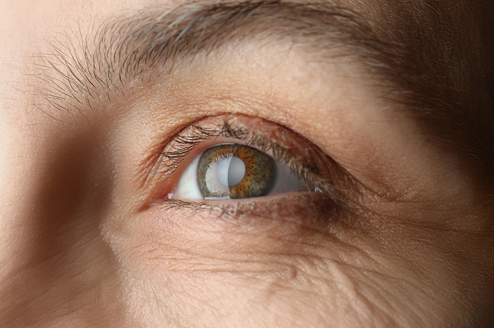 Potential Complications of Cataract Surgery: what you need to know