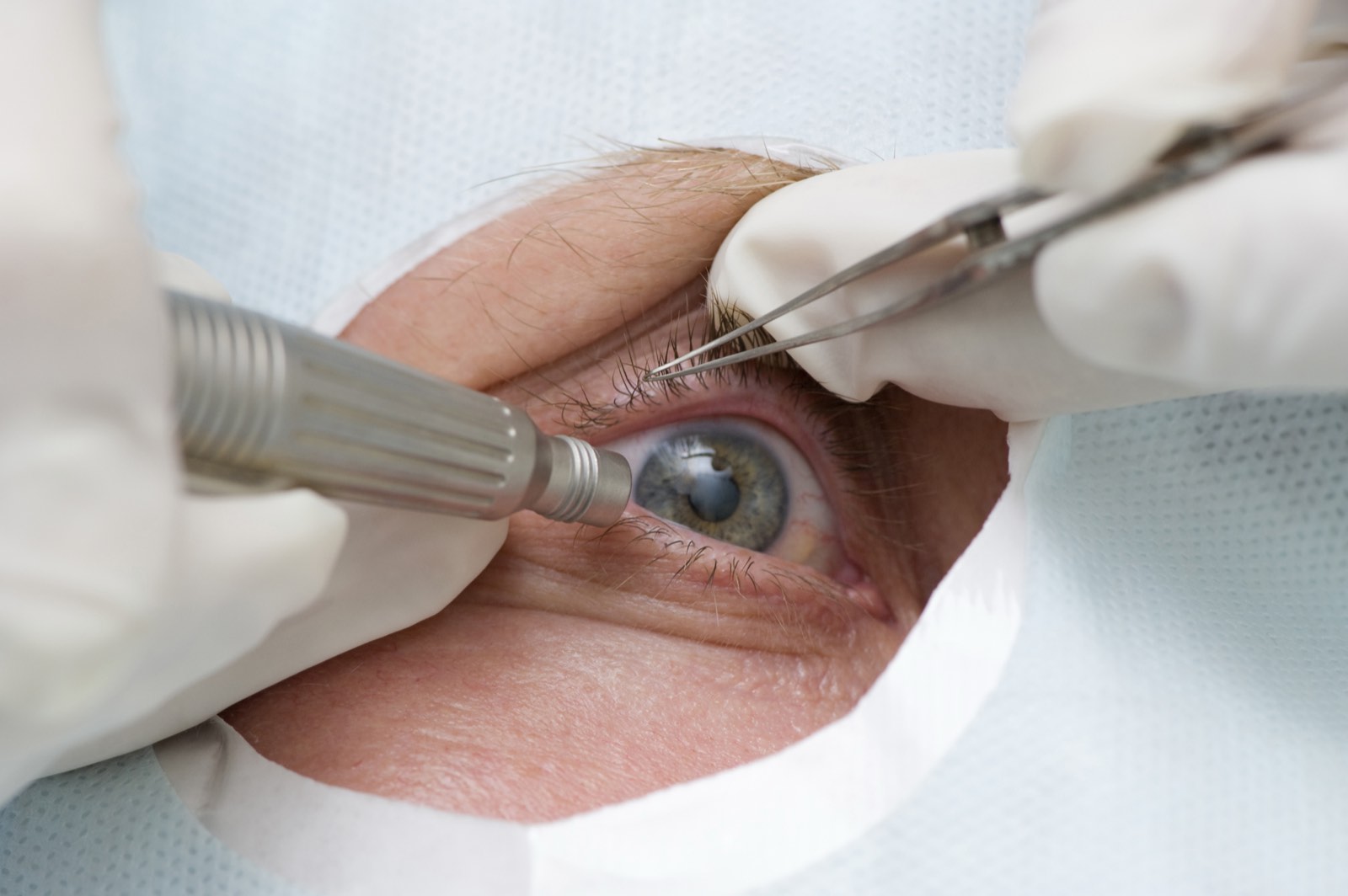 Why Cataract Anesthesia is Not One-Size-Fits-All