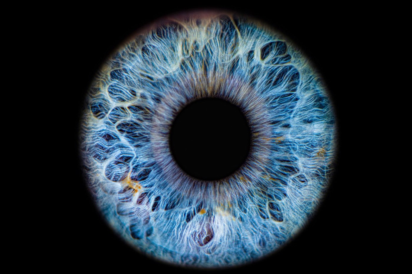 Negative Dysphotopsia: A Cataract Surgery Nightmare